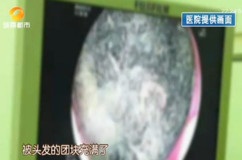 探索與警示，一名9歲女孩胃中取出直徑四厘米頭發(fā)團的故事，9歲女孩胃中取出四厘米頭發(fā)團，探索與警示的故事