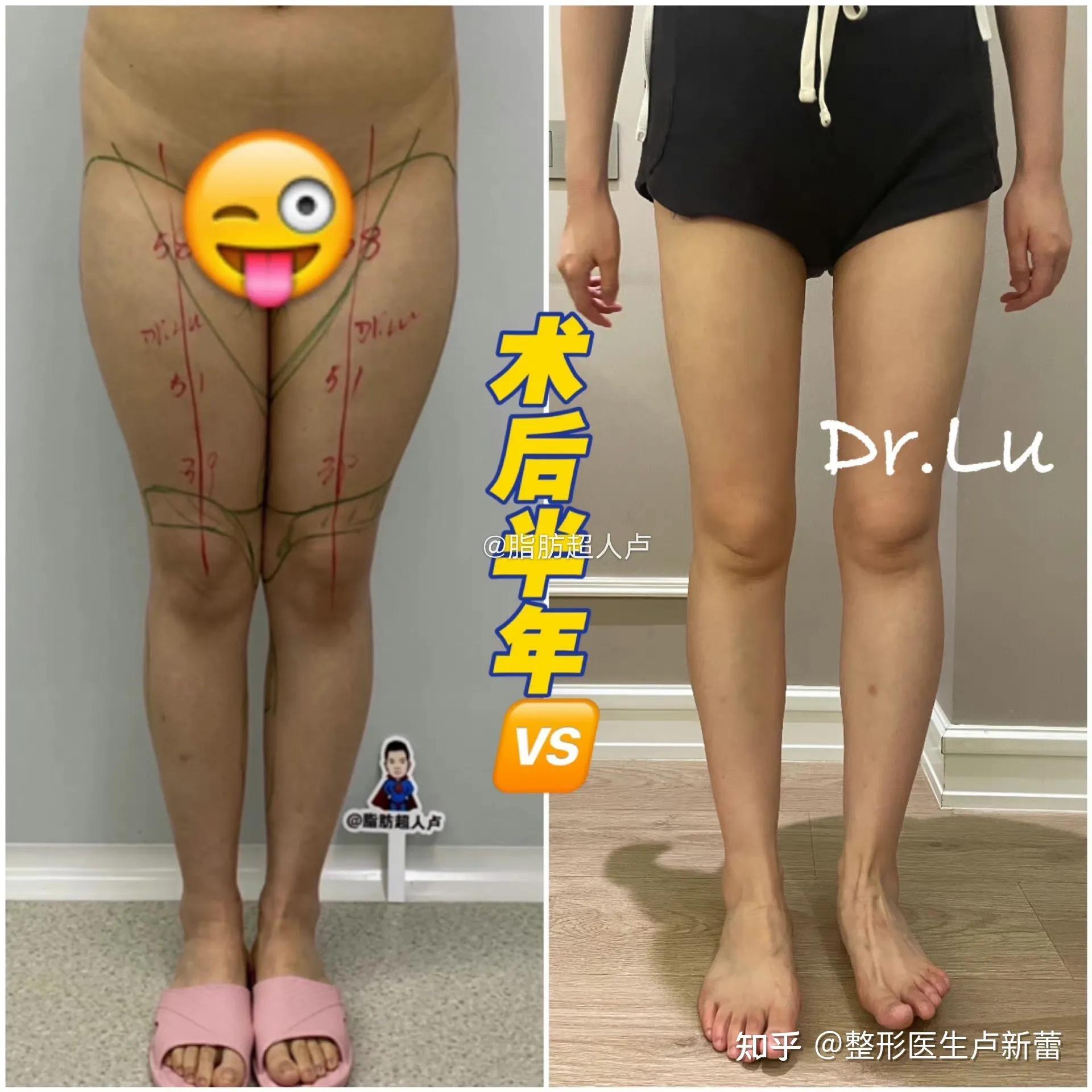 抽脂大腿最新技術(shù)，探索美麗的新境界，探索最新大腿抽脂技術(shù)，重塑美麗新境界