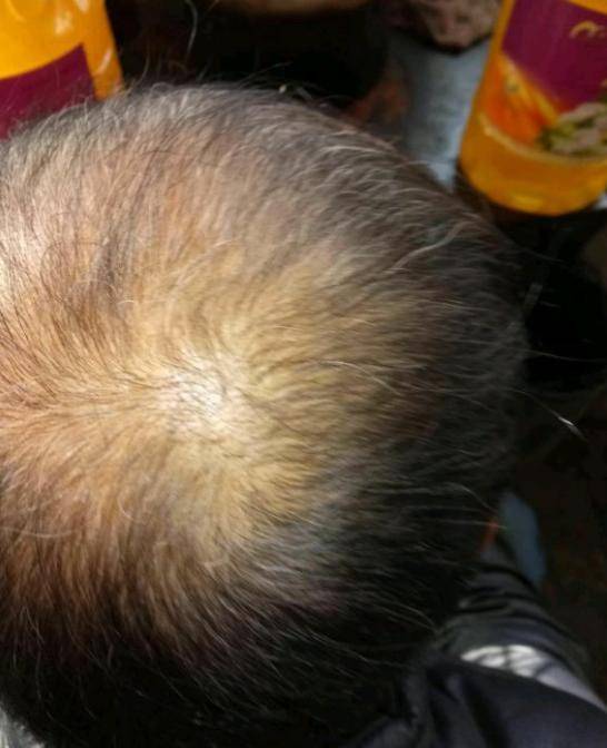 青春的挑戰(zhàn)與遺傳的秘密，一個16歲男孩的禿頭故事，青春的挑戰(zhàn)與遺傳之謎，一個16歲男孩的禿頭故事探索