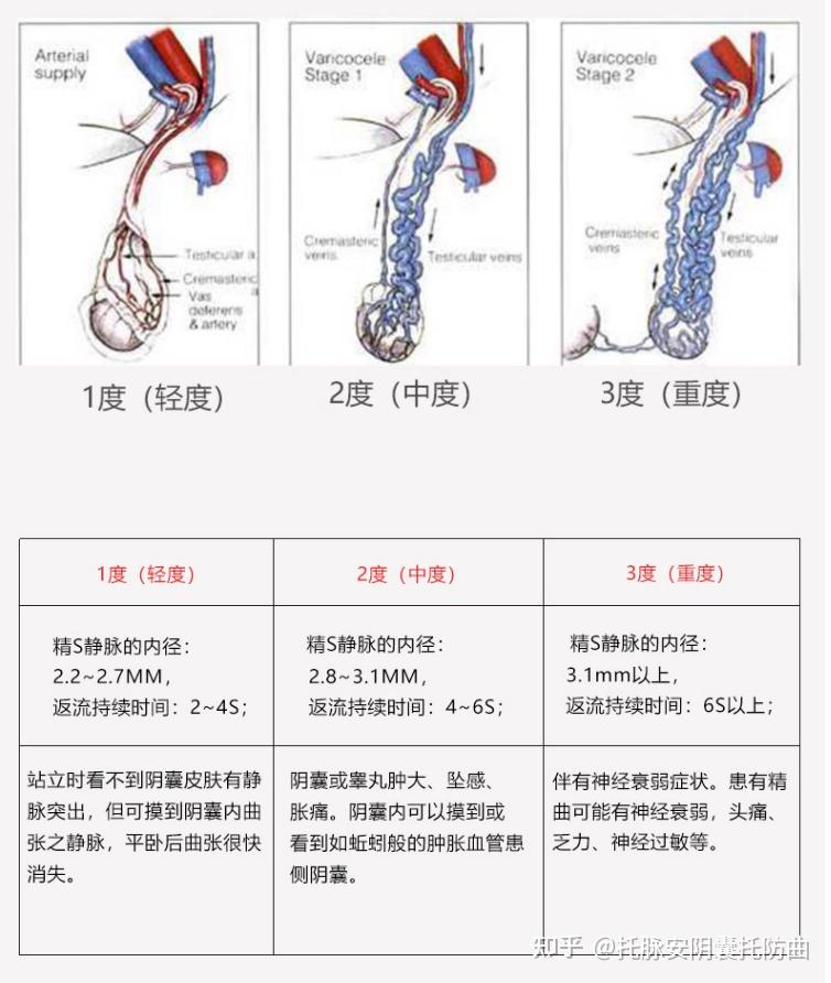 精索靜脈曲張三個(gè)程度圖詳解，精索靜脈曲張三個(gè)程度詳解圖解