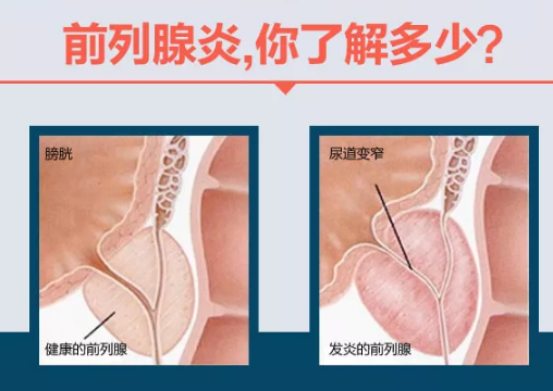 前列腺炎的治愈可能性，理解與探索，前列腺炎的治愈可能性，深入理解與探索