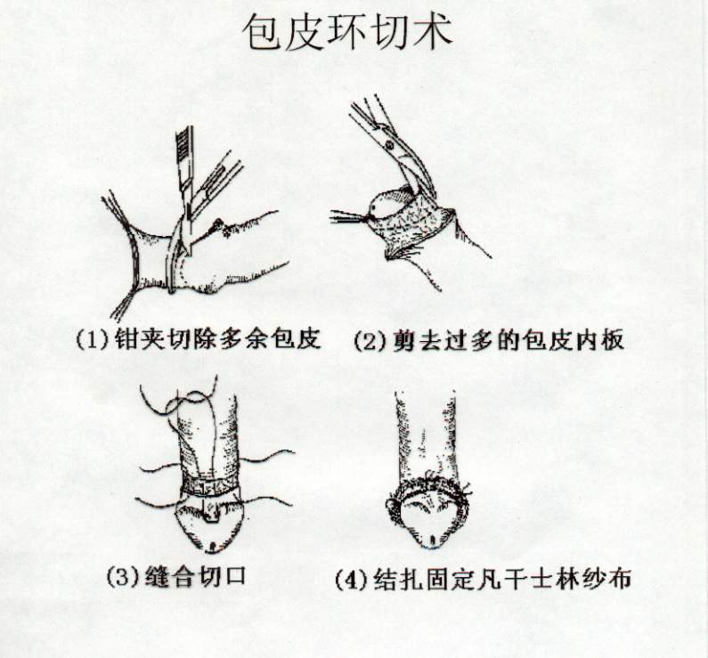 關(guān)于包皮手術(shù)后多久可以同房的問題解答，包皮手術(shù)后恢復(fù)與同房時(shí)間指南