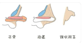 正規(guī)包莖手術(shù)費(fèi)用詳解，正規(guī)包莖手術(shù)費(fèi)用全面解析