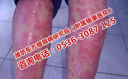 治療銀屑病的最新方法，探索與創(chuàng)新，探索銀屑病治療的新領(lǐng)域，最新治療方法與創(chuàng)新技術(shù)