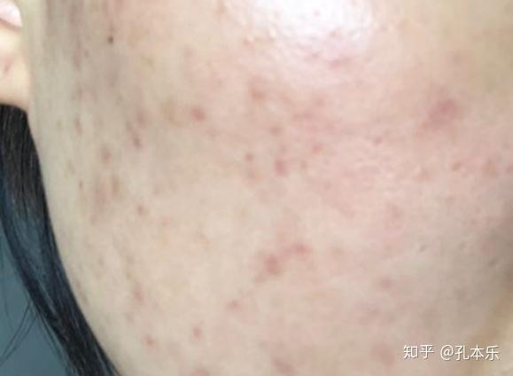 毛囊炎圖片，認(rèn)識與理解毛囊炎的直觀方式，毛囊炎圖片，直觀認(rèn)識與理解毛囊炎的指南