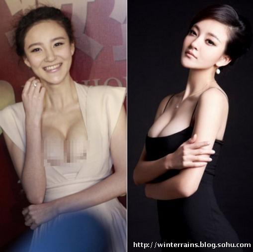 揭秘娛樂圈，哪些女明星選擇了隆胸手術？，揭秘娛樂圈女明星的隆胸手術選擇