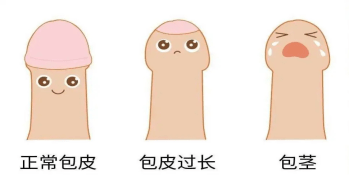 如何判斷包莖過長(zhǎng)？深入了解包莖過長(zhǎng)的相關(guān)知識(shí)，包莖過長(zhǎng)的判斷與深入了解，全面解析包莖過長(zhǎng)相關(guān)知識(shí)