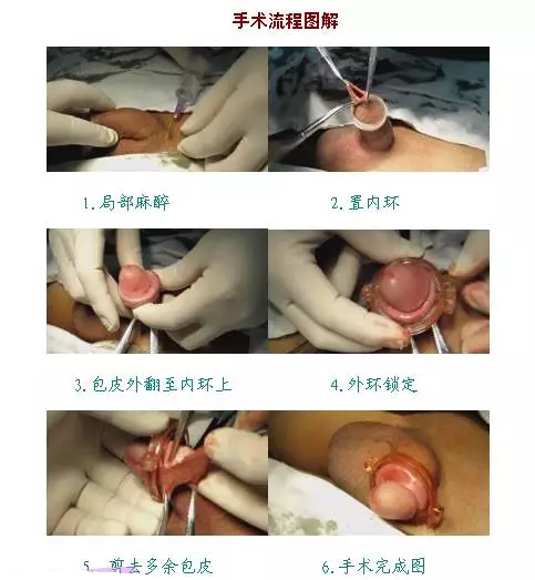 外國(guó)環(huán)切手術(shù)真人圖片，揭示現(xiàn)代醫(yī)學(xué)的進(jìn)步與重要性，外國(guó)環(huán)切手術(shù)真人圖片，展現(xiàn)現(xiàn)代醫(yī)學(xué)進(jìn)步與重要性