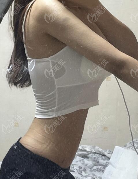 肚子抽脂10斤的價格，因素與費用探討，肚子抽脂價格解析，費用、因素全探討，10斤抽脂價格一覽