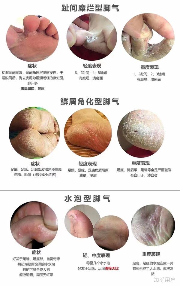 腳氣根治偏方，探索有效的自然療法，腳氣根治偏方，自然療法探索與有效性探討