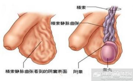 精索靜脈曲張可以自愈嗎？解析與探討，精索靜脈曲張能否自愈？解析與探討