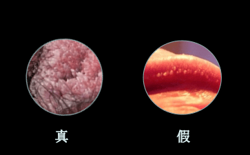 感染尖銳疣10天癥狀，感染尖銳疣10天癥狀詳解