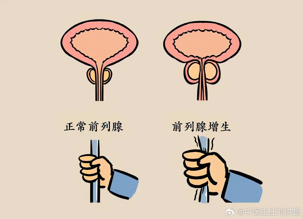 前列腺結(jié)石與性功能障礙，是否存在關(guān)聯(lián)？，前列腺結(jié)石與性功能障礙的關(guān)聯(lián)探討，是否存在潛在聯(lián)系？