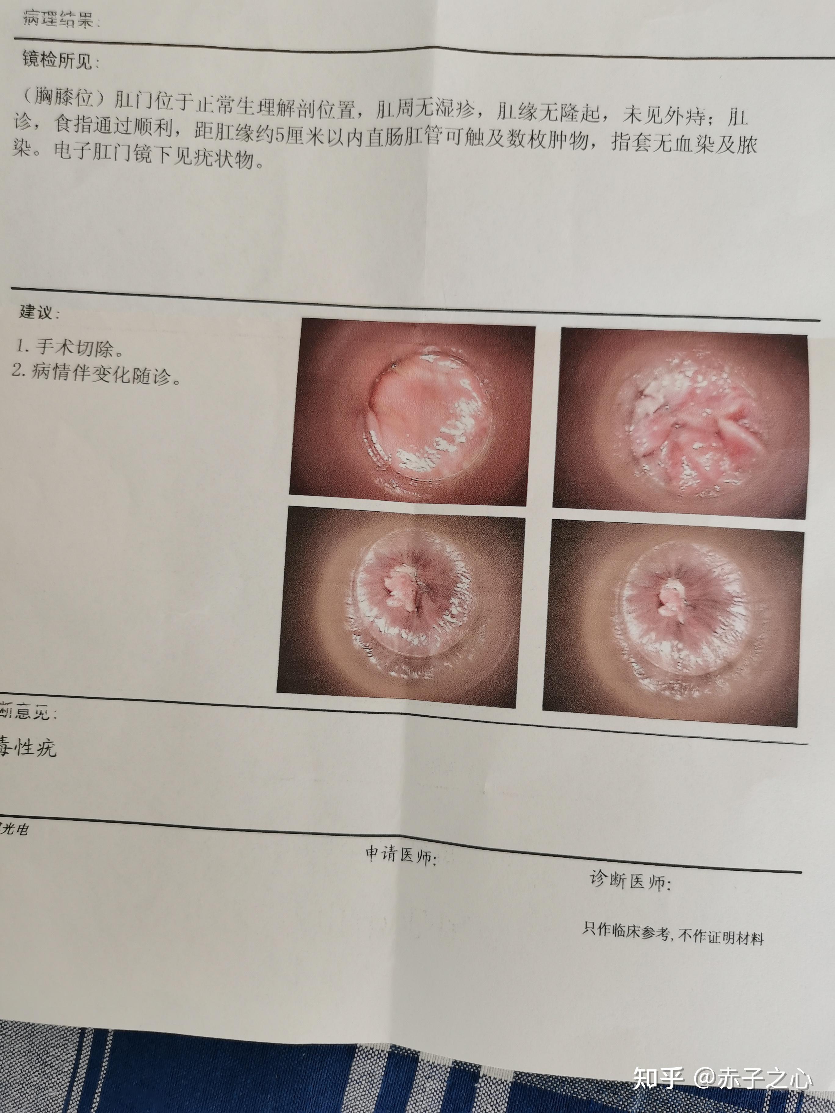 患者尖銳治愈的真實(shí)過程，患者尖銳濕癥的治愈之路
