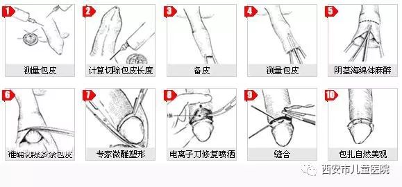 關(guān)于做包皮手術(shù)是否疼痛，一種全面的解讀與應(yīng)對(duì)建議，包皮手術(shù)疼痛解讀及應(yīng)對(duì)建議，全面解析與指導(dǎo)