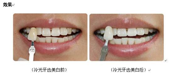 美白牙齒，打造燦爛笑容的關(guān)鍵步驟，美白牙齒，燦爛笑容的秘訣與關(guān)鍵步驟